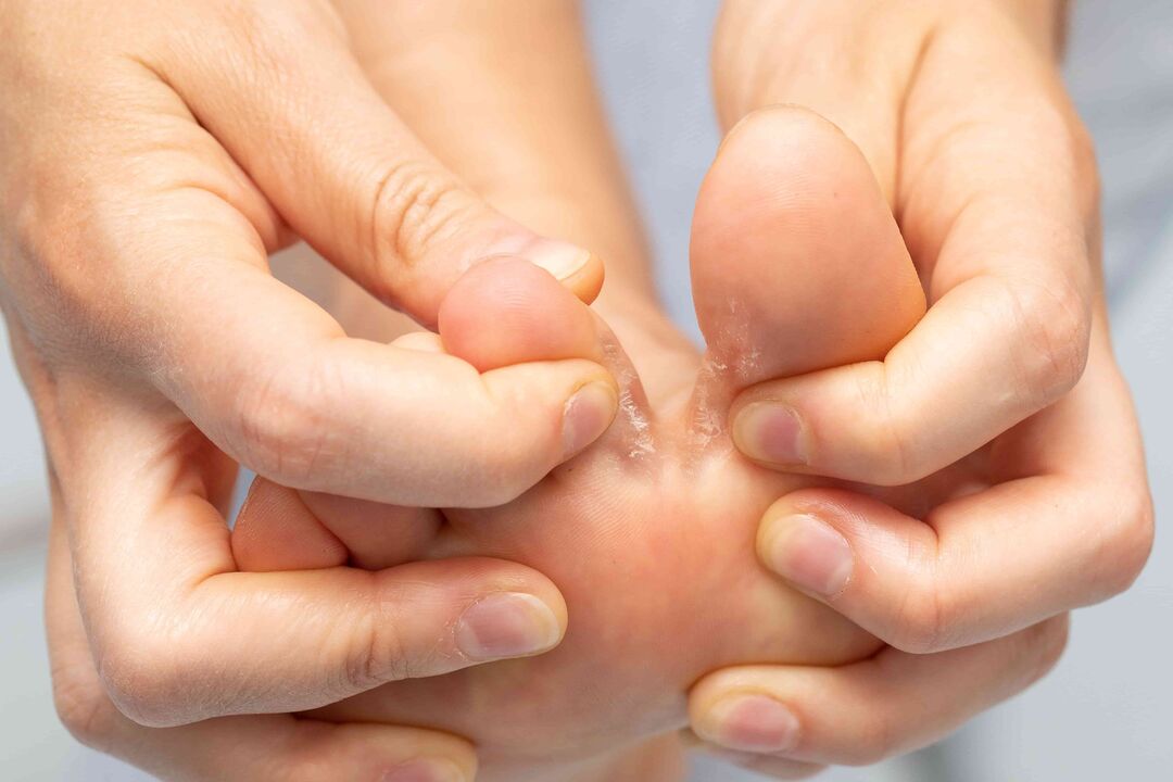 Fungi between fingers and its treatment with zxcvbnmqwert cream