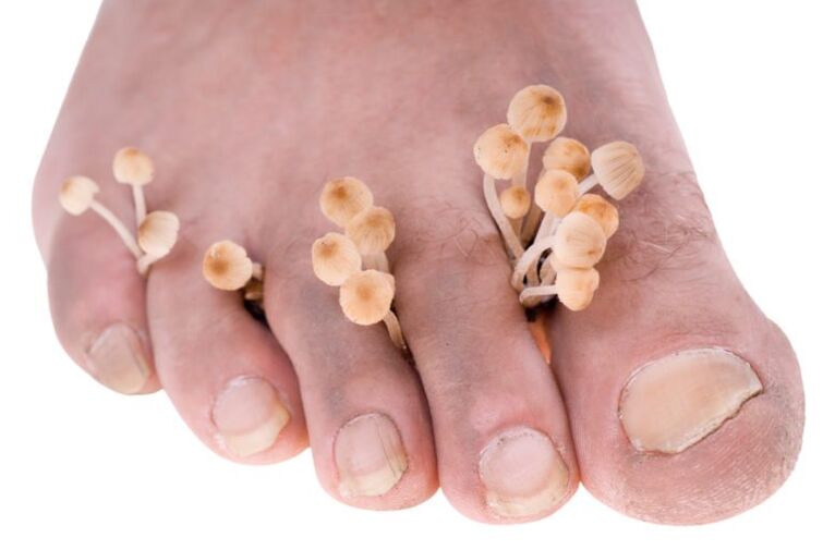 Fungi in the symptoms of the legs