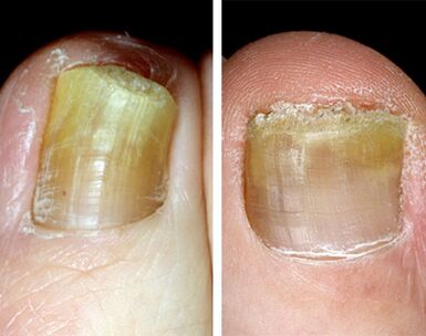 Distal form of onychomycosis on the foot