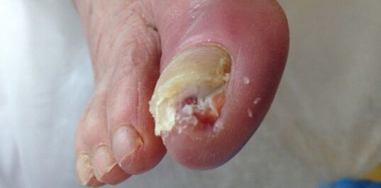 Tank and source of dermatophytic fungi is a sick person