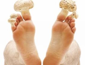 How to treat toenail fungus